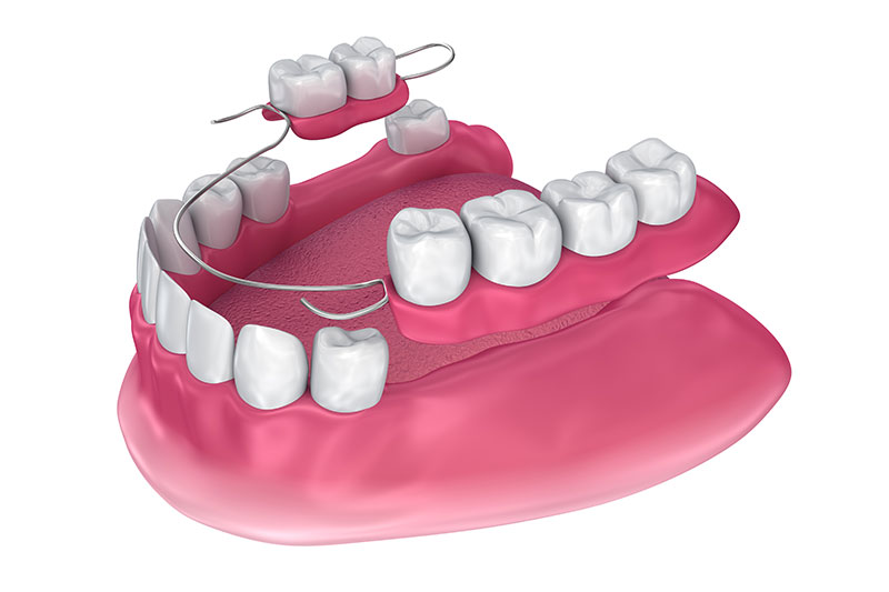 Partial Dentures in Slidell